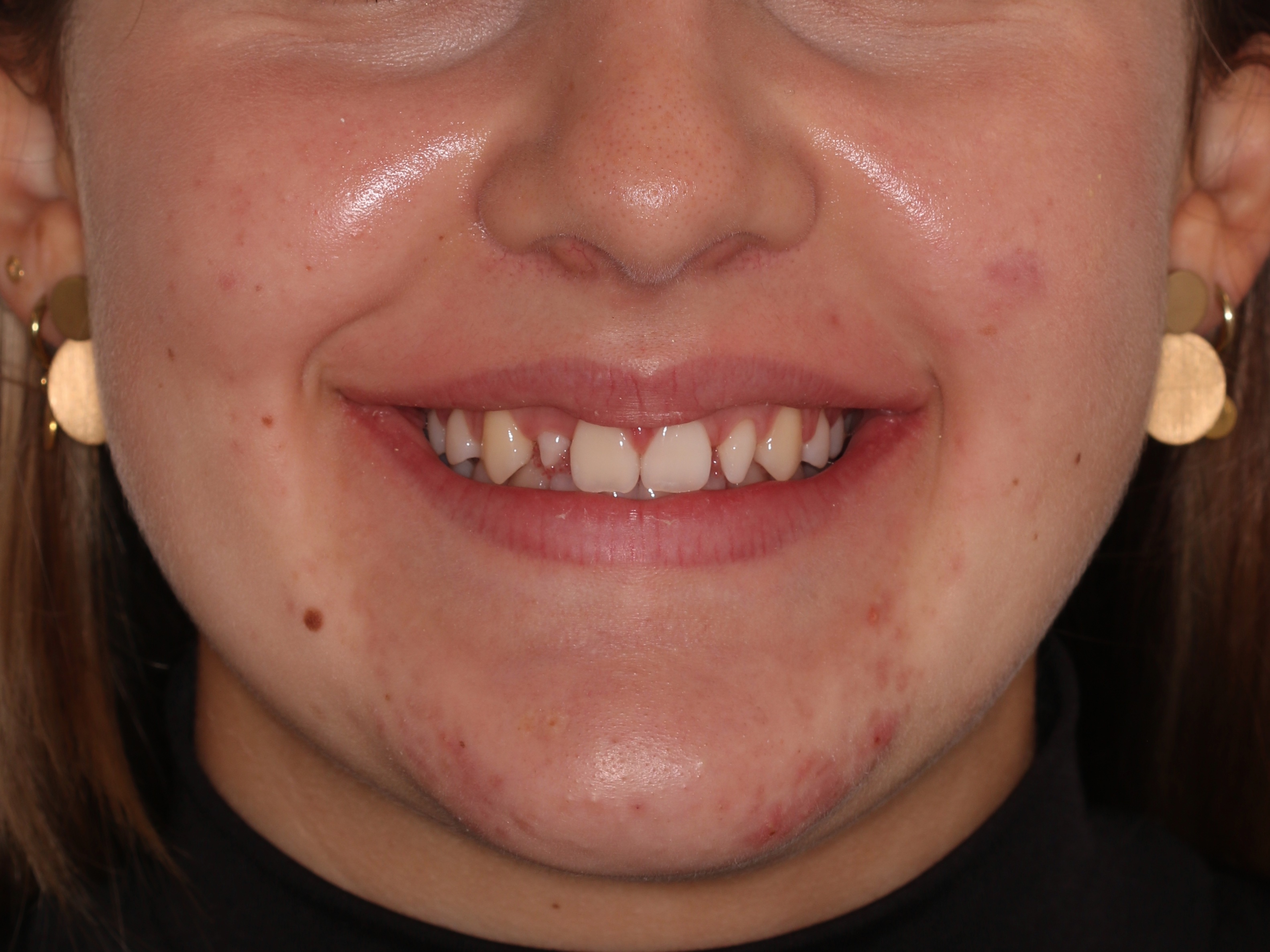 Before orthodontic treatment - Orthodontic Treatment + Aesthetic Restorations for the Resolution of Dental Shape Anomalies