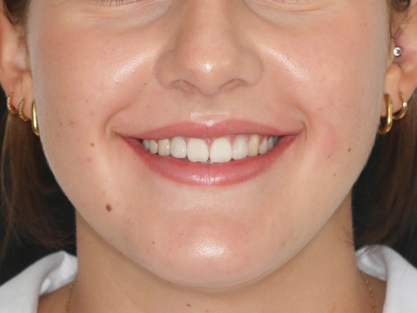 After orthodontic treatment - Orthodontic Treatment + Aesthetic Restorations for the Resolution of Dental Shape Anomalies