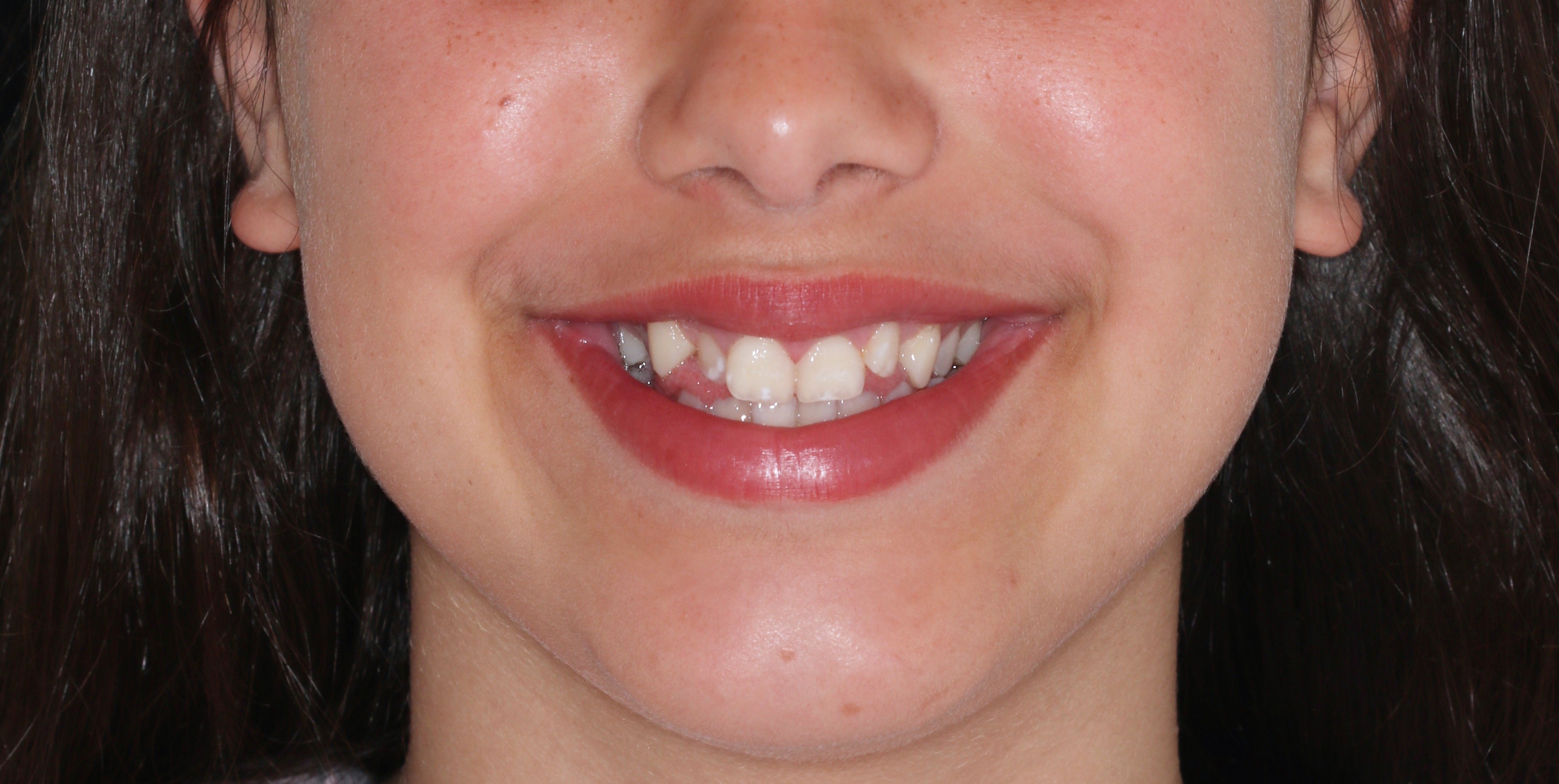 Before orthodontic treatment - Expansion with Fixed Appliance and Skeletal Anchorage