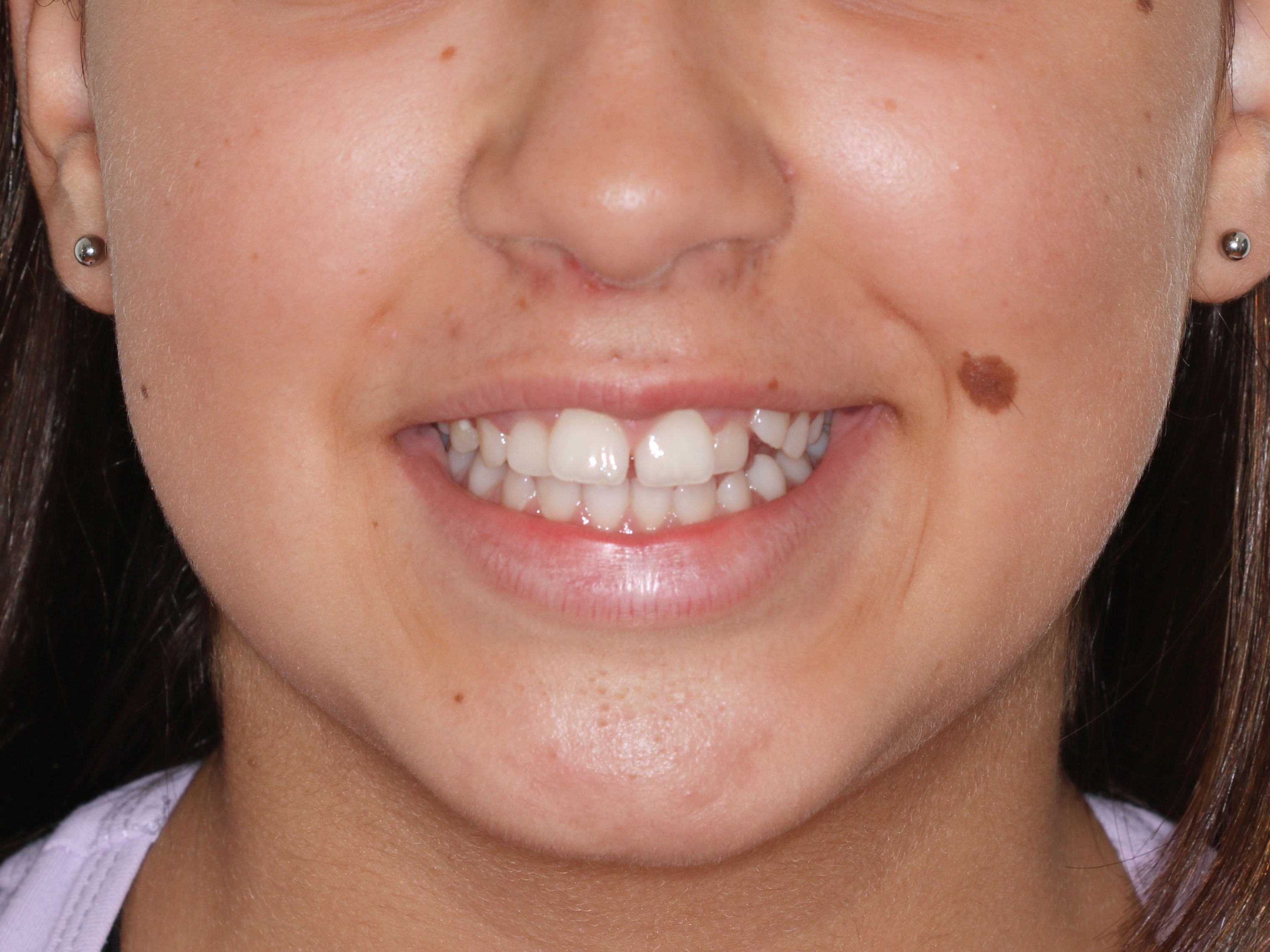 Before orthodontic treatment - Complex Orthodontic Treatment with Fixed Bimaxilar Appliance