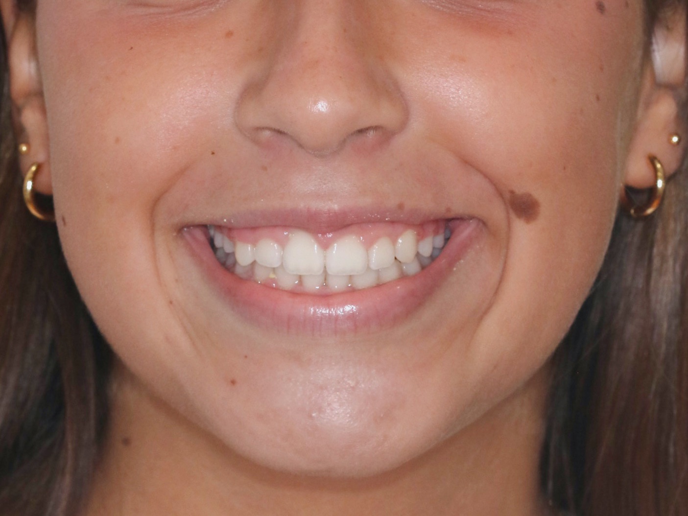 After orthodontic treatment - Complex Orthodontic Treatment with Fixed Bimaxilar Appliance